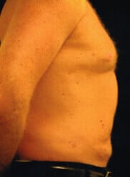 After Image: Male Breast Reduction (Gynecomastia) - right-side