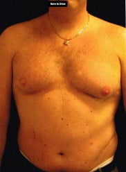 Before Image: Male Breast Reduction (Gynecomastia) - front