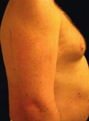 Before Image: Male Breast Reduction (Gynecomastia) - right-side