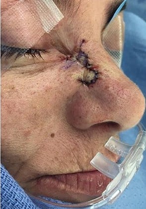 After Image: Mohs Surgery Reconstruction - right-front-oblique