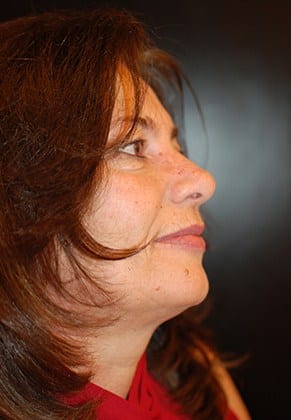 After Image: Mohs Surgery Reconstruction - right-front-oblique