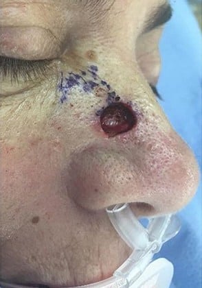 Before Image: Mohs Surgery Reconstruction - right-front-oblique