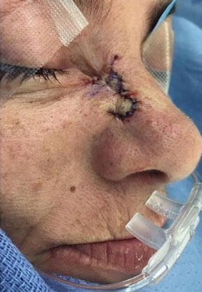 Before Image: Mohs Surgery Reconstruction - right-front-oblique