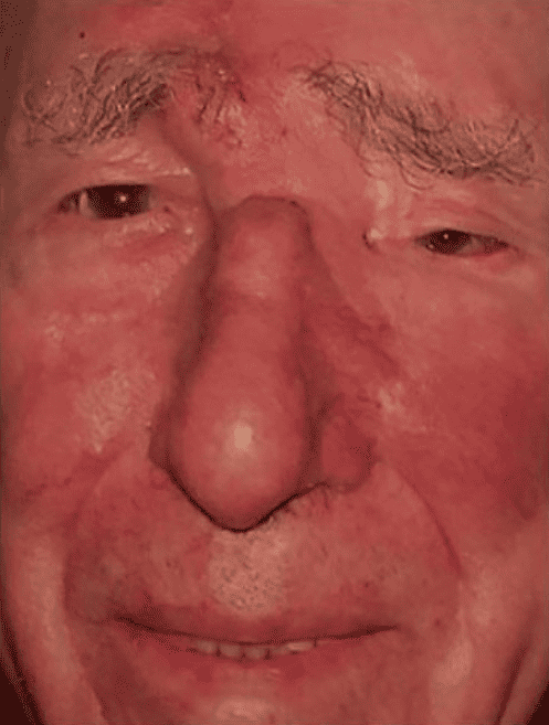 After Image: Mohs Surgery Reconstruction - front