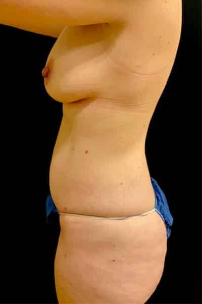 After Image: Mommy Makeover - left-side