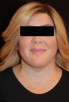 After Image: Neck Lift - front