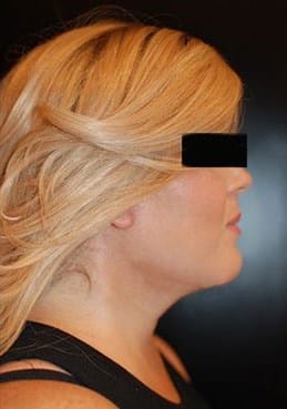 After Image: Neck Lift - right-side