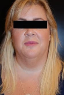 Before Image: Neck Lift - front