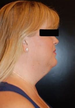 Before Image: Neck Lift - right-side