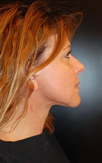 After Image: Neck Lift - right-side