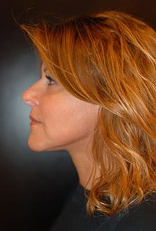After Image: Neck Lift - left-side