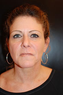 Before Image: Neck Lift - front