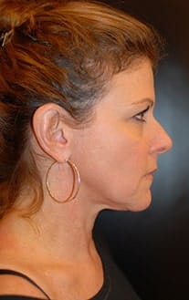 Before Image: Neck Lift - right-side