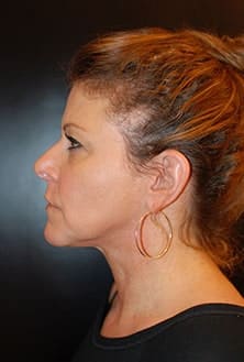Before Image: Neck Lift - left-side