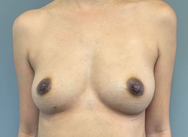 After Image: Nipple Reduction - front