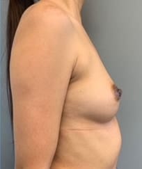 After Image: Nipple Reduction - right-side