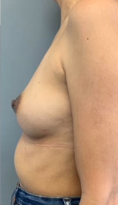 After Image: Nipple Reduction - left-side