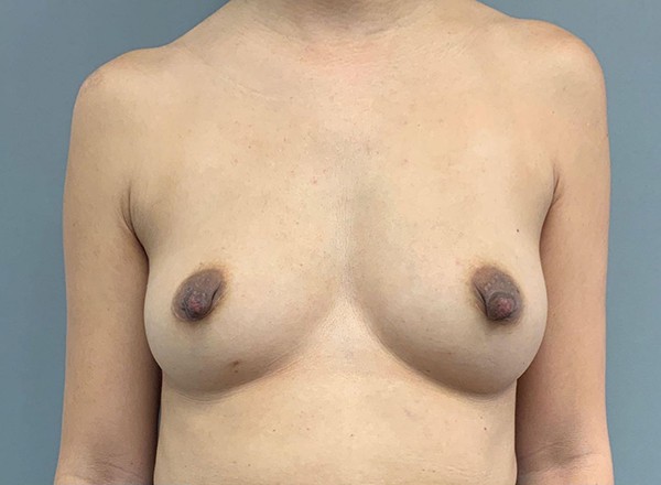 Before Image: Nipple Reduction - front