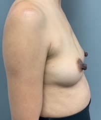 Before Image: Nipple Reduction - right-side