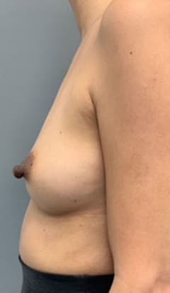 Before Image: Nipple Reduction - left-side