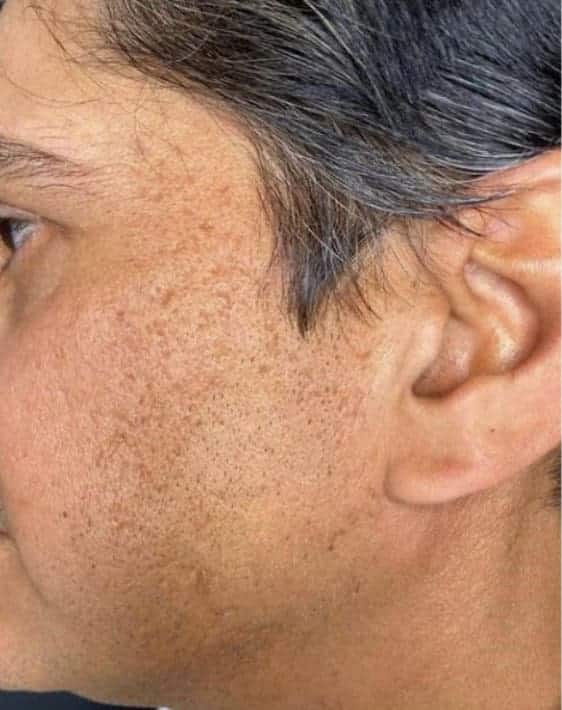 After Image: RF Microneedling - left-side