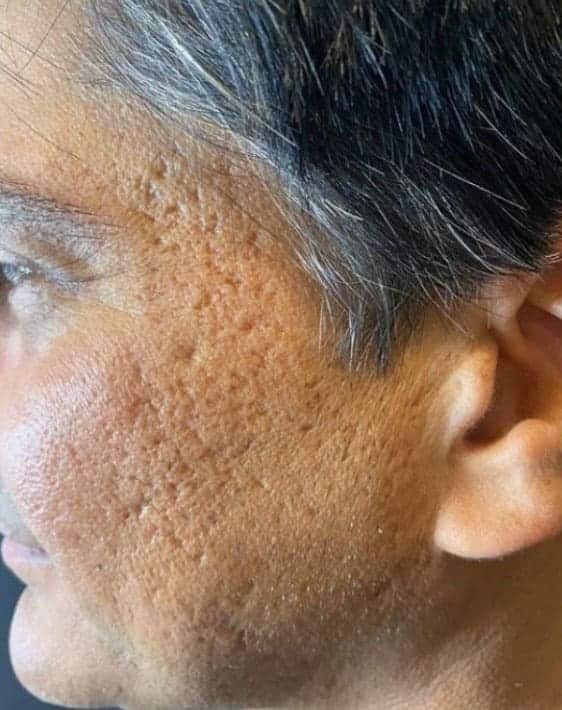 Before Image: RF Microneedling - left-side