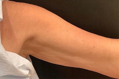 After Image: RF Microneedling - front