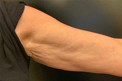 Before Image: RF Microneedling - front