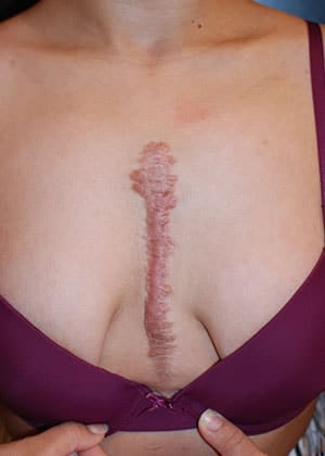 Before Image: Scar Revision - front