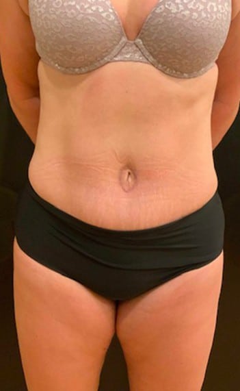 After Image: Tummy Tuck (Abdominoplasty) - front