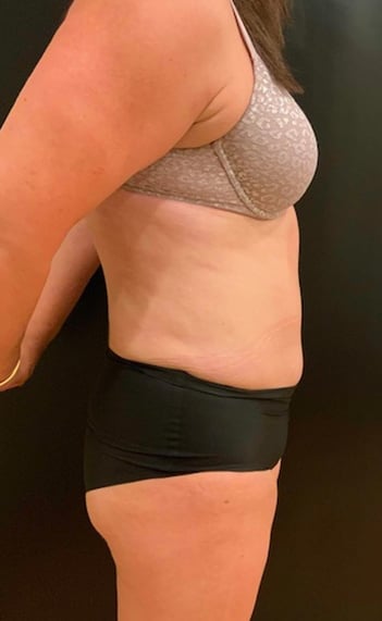 After Image: Tummy Tuck (Abdominoplasty) - right-side