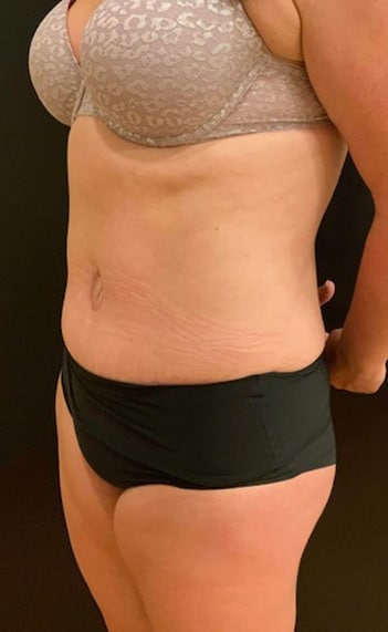 After Image: Tummy Tuck (Abdominoplasty) - left-front-oblique