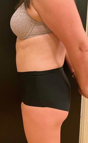 After Image: Tummy Tuck (Abdominoplasty) - left-side