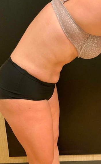 After Image: Tummy Tuck (Abdominoplasty) - right-side