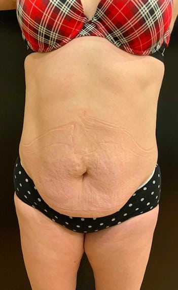 Before Image: Tummy Tuck (Abdominoplasty) - front
