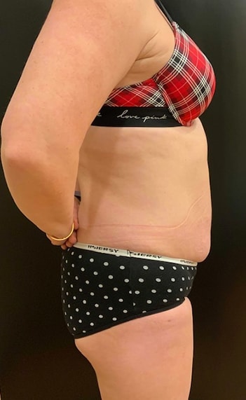 Before Image: Tummy Tuck (Abdominoplasty) - right-side