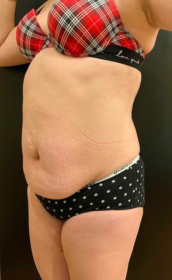 Before Image: Tummy Tuck (Abdominoplasty) - left-front-oblique