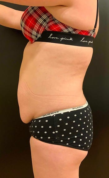 Before Image: Tummy Tuck (Abdominoplasty) - left-side