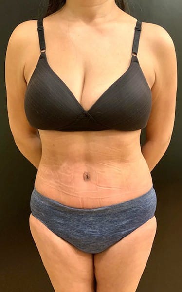 After Image: Tummy Tuck (Abdominoplasty) - front