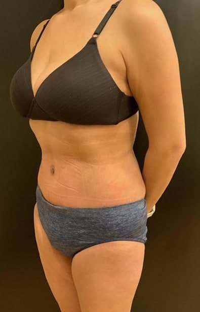 After Image: Tummy Tuck (Abdominoplasty) - left-front-oblique