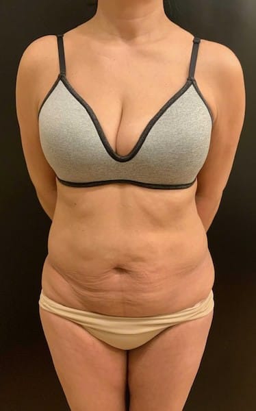 Before Image: Tummy Tuck (Abdominoplasty) - front