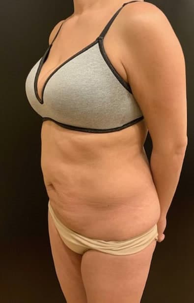 Before Image: Tummy Tuck (Abdominoplasty) - left-front-oblique