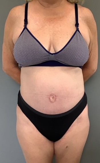 After Image: Tummy Tuck (Abdominoplasty) - front