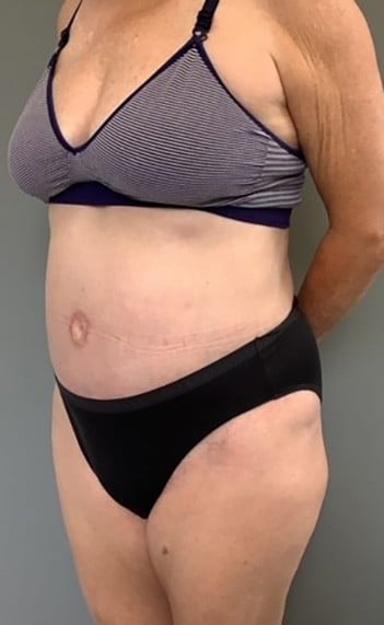 After Image: Tummy Tuck (Abdominoplasty) - left-front-oblique