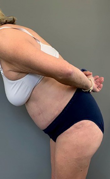 After Image: Tummy Tuck (Abdominoplasty) - left-side