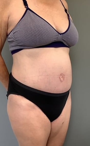 After Image: Tummy Tuck (Abdominoplasty) - right-front-oblique