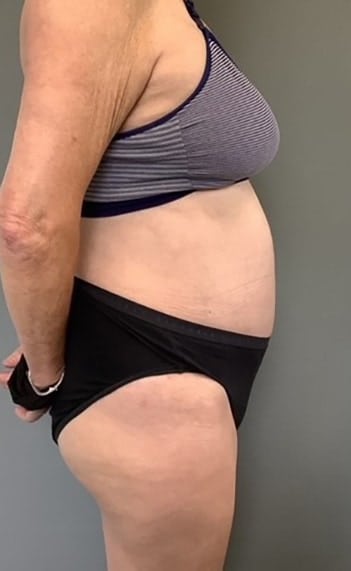 After Image: Tummy Tuck (Abdominoplasty) - right-side