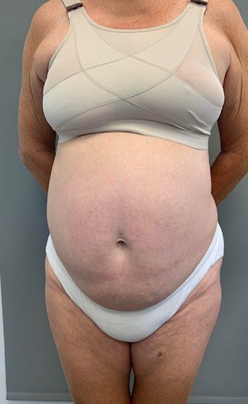 Before Image: Tummy Tuck (Abdominoplasty) - front
