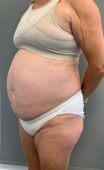 Before Image: Tummy Tuck (Abdominoplasty) - left-front-oblique