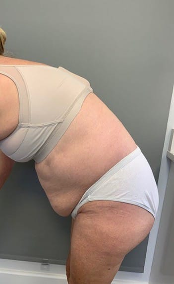 Before Image: Tummy Tuck (Abdominoplasty) - left-side